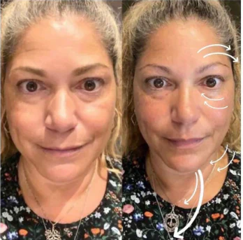 LymphLift™ Brush